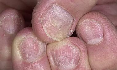 Лечение псориаза ногтей: эффективные средства